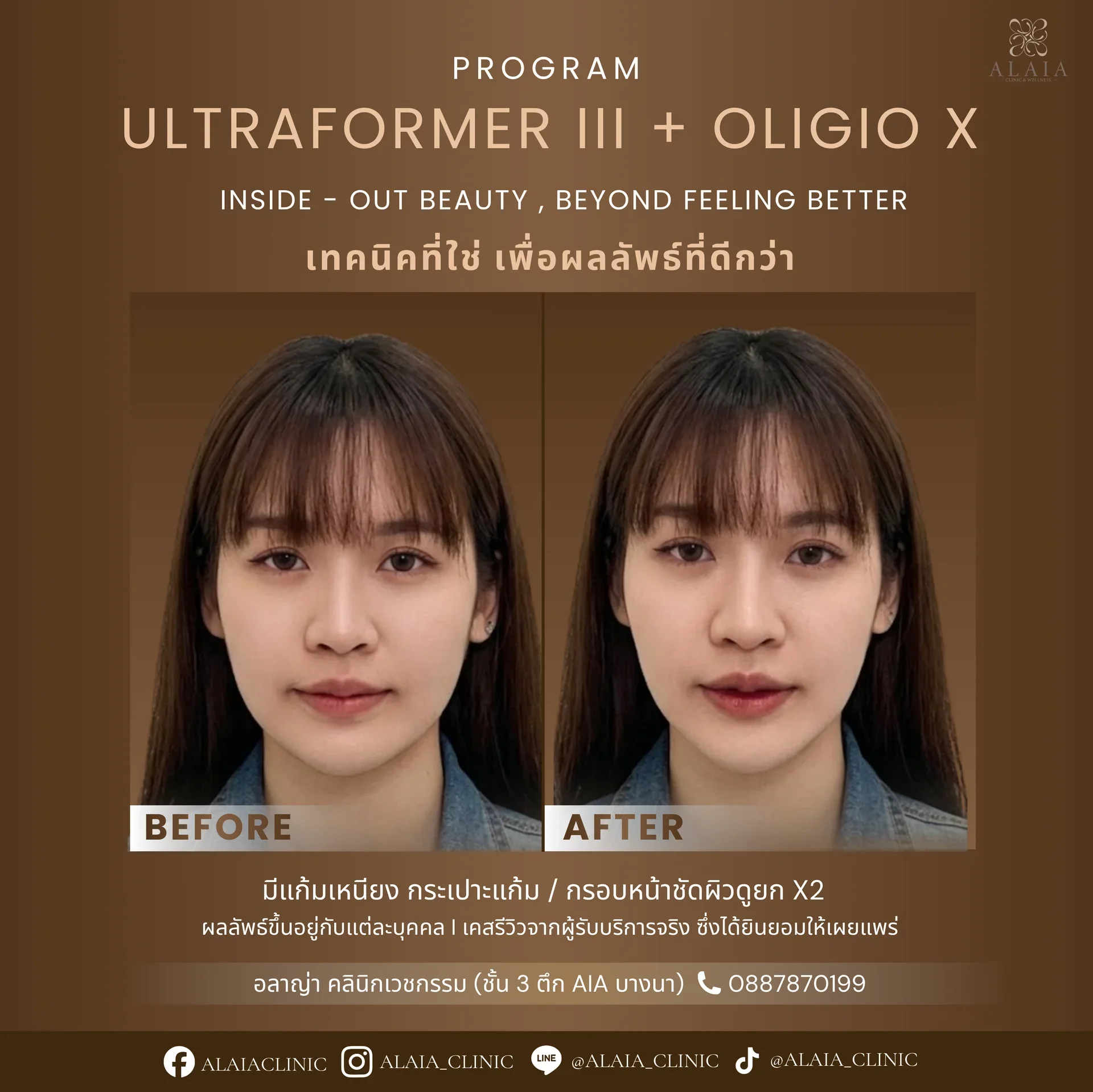 Program Ultraformer III & Oligio X Review